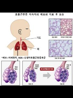 [x]신생아호흡곤란증후군의 개념 - YouTube