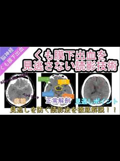 [x]くも膜下出血を見逃さない読影技術 - YouTube